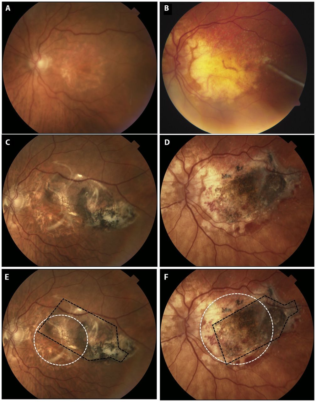 Do stem cells for vision loss offer real hope?