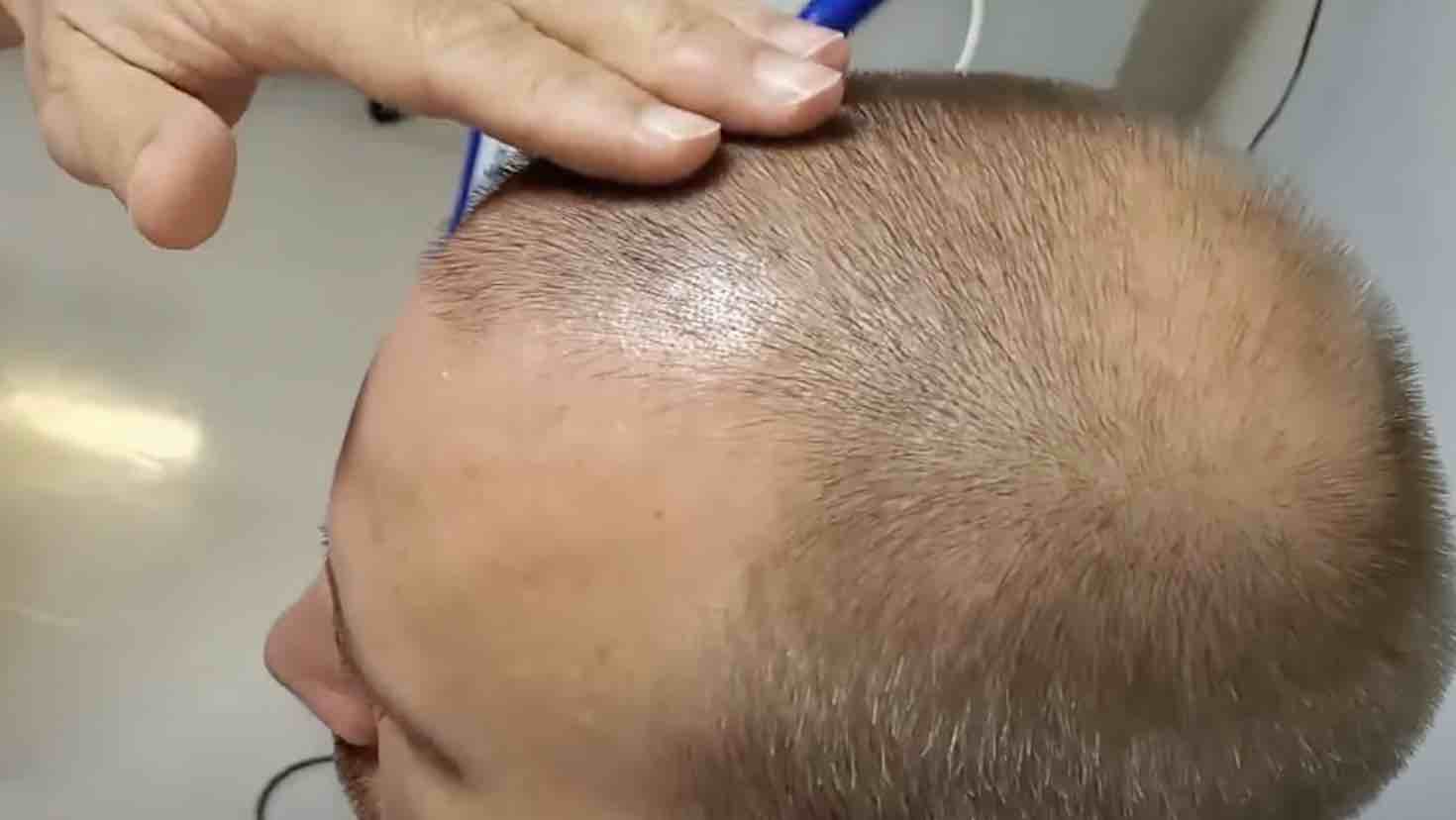 Review of stem cell hair transplant for baldness - The Niche