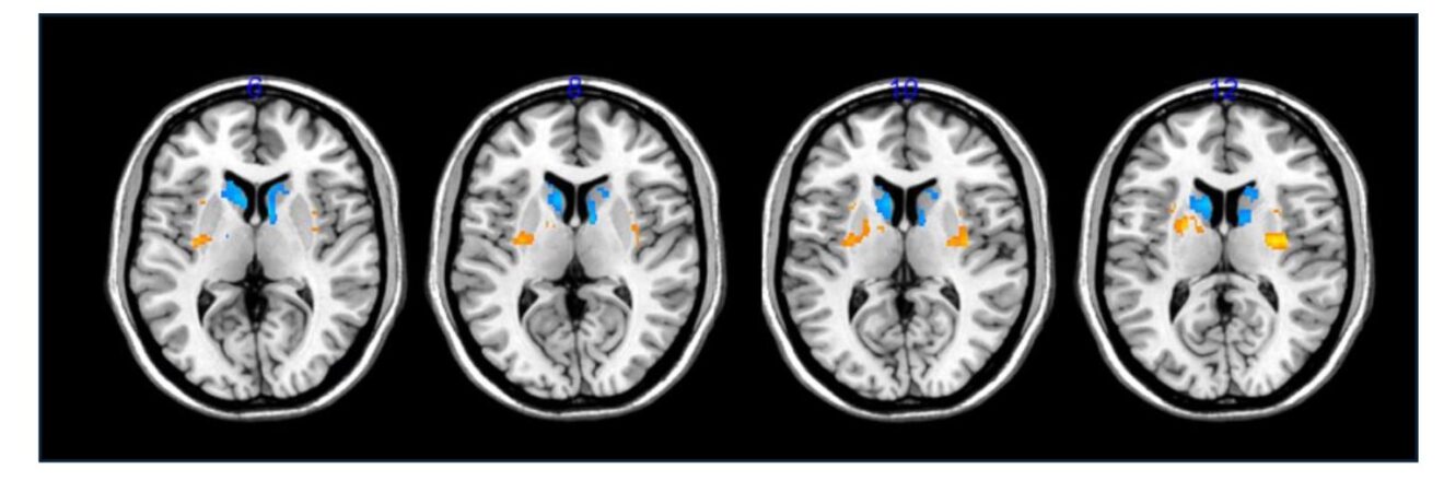 BlueRock Therapeutics, Parkinson's disease, brain imaging